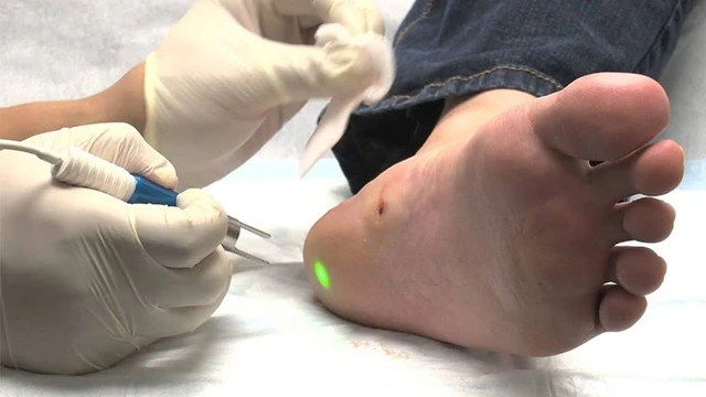 bai-viet/dot-mun-coc-bang-laser-va-nhung-luu-y-can-biet-58690.html