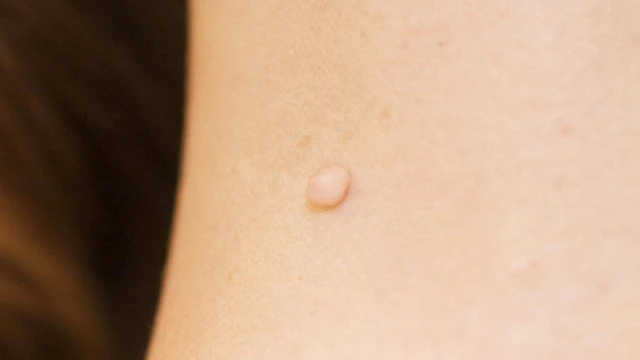 bai-viet/dot-mun-thit-gia-bao-nhieu-cach-cham-soc-sau-khi-dot-mun-thit.html