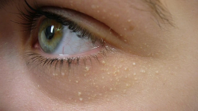 bai-viet/dot-mun-thit-kieng-an-gi-de-khong-bi-seo-va-nhanh-lanh.html