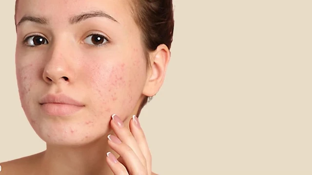 bai-viet/dung-aspirin-tri-mun-co-that-su-an-toan-va-hieu-qua-hay-khong-70152.html