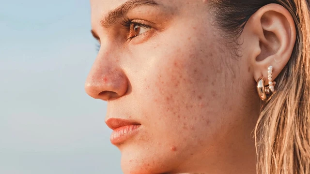 bai-viet/tai-sao-dung-kem-chong-nang-bi-mun-chon-kem-chong-nang-khong-so-mun.html