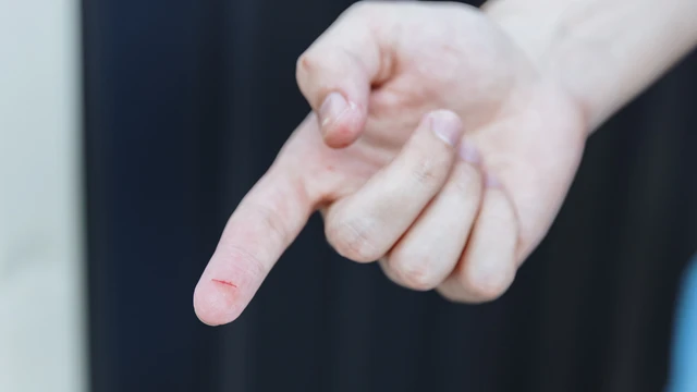 bai-viet/dut-tay-mau-chay-khong-ngung-phai-lam-gi.html