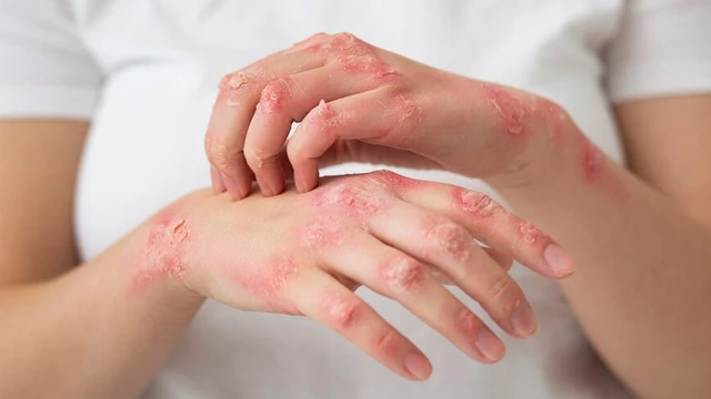 bai-viet/eczema-main-nguyen-nhan-trieu-chung-va-phuong-phap-dieu-tri.html