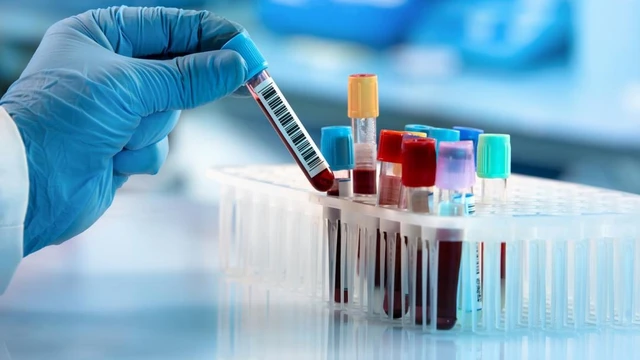 bai-viet/fructosamine-la-gi-y-nghia-va-vai-tro-trong-theo-doi-duong-huyet.html