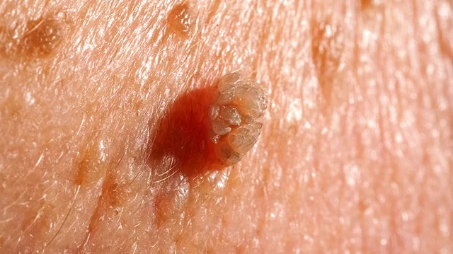 bai-viet/gai-sinh-duc-la-gi-gai-sinh-duc-co-nguy-hiem-khong.html