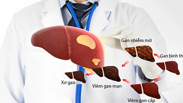 bai-viet/goc-tu-van-gan-nhiem-mo-uong-thuoc-gi.html