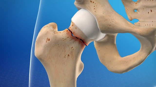 benh/gay-co-xuong-dui.html