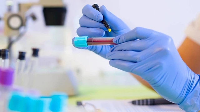 bai-viet/ggt-trong-xet-nghiem-mau-la-gi-64158.html