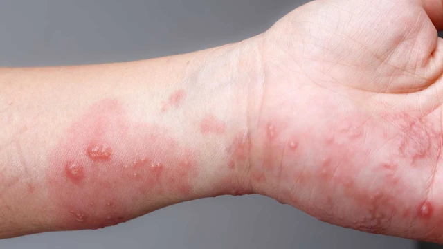 bai-viet/huong-dan-nhung-cach-tri-ghe-ngua-tai-nha-an-toan-hieu-qua.html