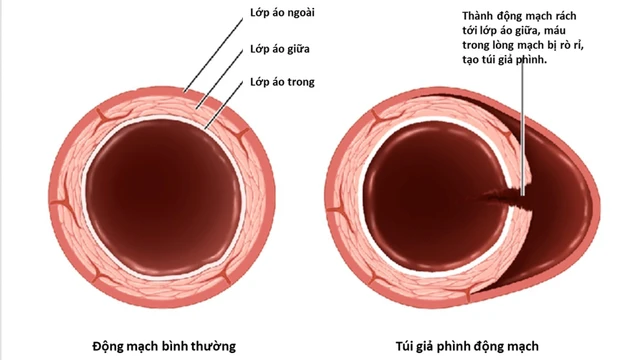 bai-viet/phuong-phap-dieu-tri-gia-phinh-dong-mach-do-thong-tim.html