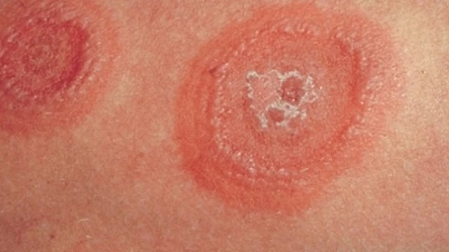 bai-viet/cach-chua-hac-lao-an-vao-mau-lau-nam-dau-hieu-nhan-biet-hac-lao-man-tinh-55687.html