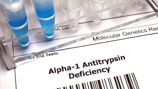 bai-viet/giai-dap-chi-tiet-ai-nen-xet-nghiem-alpha-1-antitrypsin-aat.html