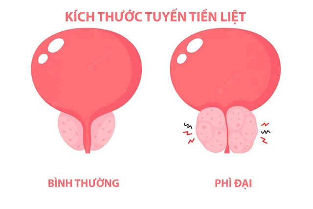 bai-viet/kich-thuoc-tien-liet-tuyen-bao-nhieu-phai-mo-63531.html
