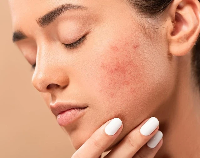 bai-viet/giai-dap-tay-not-ruoi-bao-lau-thi-boi-kem-tri-seo.html