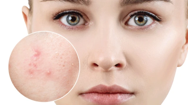 bai-viet/giai-dap-thac-mac-an-dau-phong-co-noi-mun-khong.html