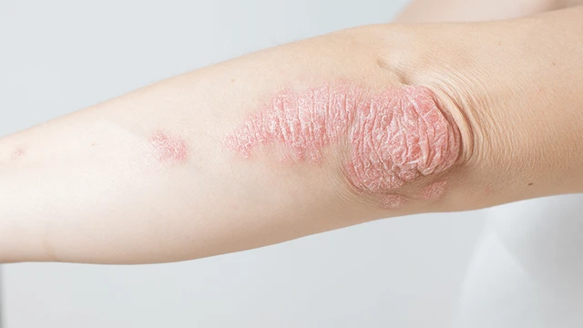 bai-viet/giai-dap-thac-mac-benh-vay-nen-a-sung-co-lay-khong-72105.html