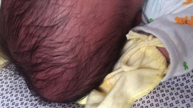 bai-viet/giai-dap-thac-mac-buou-huyet-thanh-o-tre-so-sinh-bao-lau-thi-het.html