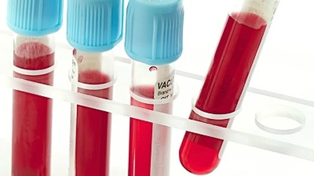 bai-viet/giai-dap-thac-mac-chi-so-wbc-trong-xet-nghiem-mau-la-gi-68482.html