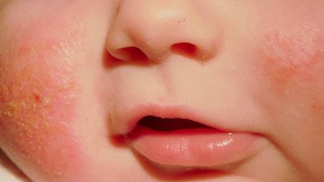 bai-viet/giai-dap-thac-mac-kem-ham-bepanthen-balm-co-tri-duoc-cham-sua-khong-58306.html