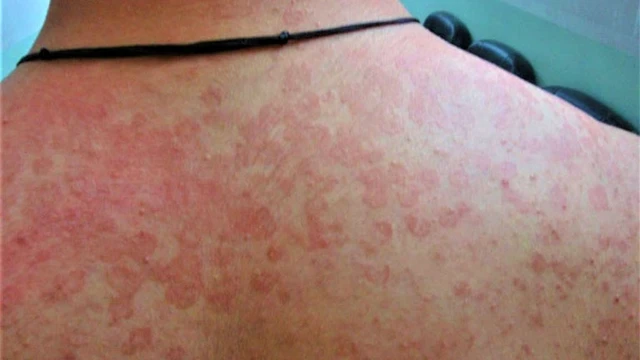 bai-viet/giai-dap-thac-mac-lang-beng-do-co-lay-khong-53357.html