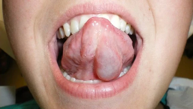 bai-viet/giai-dap-thac-mac-u-nang-duoi-luoi-co-nguy-hiem-khong.html