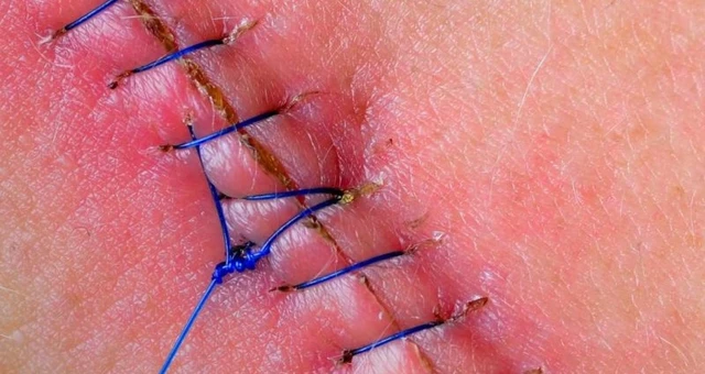 bai-viet/nguyen-nhan-va-cach-khac-phuc-vet-rach-tang-sinh-mon-bi-mung-mu-60909.html