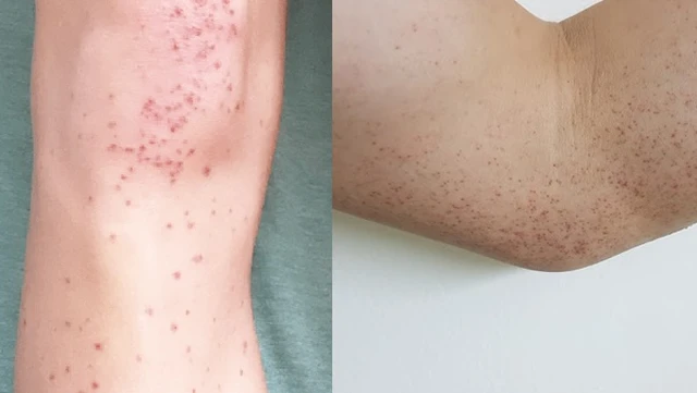 bai-viet/giai-dap-thac-mac-viem-mao-mach-di-ung-bao-lau-thi-khoi.html