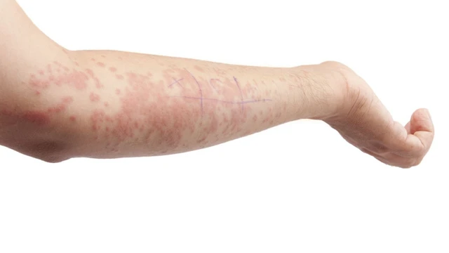 bai-viet/giai-dap-thac-mac-viem-mao-mach-di-ung-kieng-an-gi.html