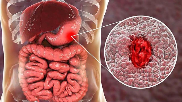 bai-viet/giai-dap-thac-mac-xuat-huyet-da-day-co-nguy-hiem-khong.html