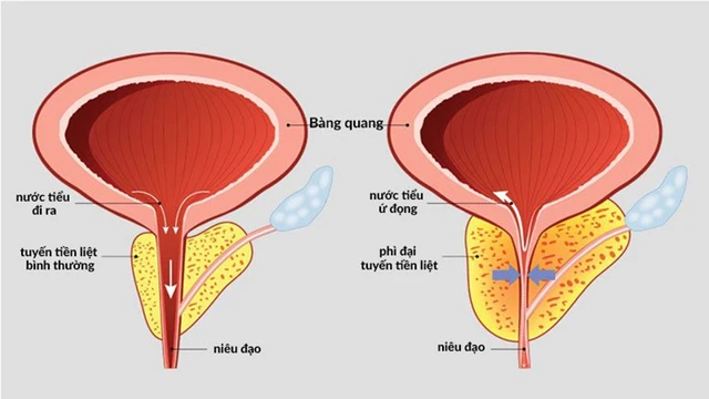 bai-viet/giai-dap-u-xo-tien-liet-tuyen-co-nen-mo-khong-63549.html