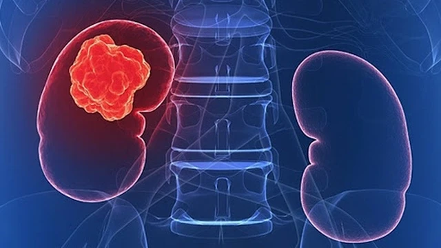 bai-viet/giai-dap-ung-thu-than-cac-loai-dieu-tri-59273.html