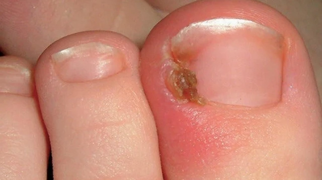 bai-viet/giai-phap-dieu-tri-dut-diem-benh-mong-choc-thit-an-toan-hieu-qua.html