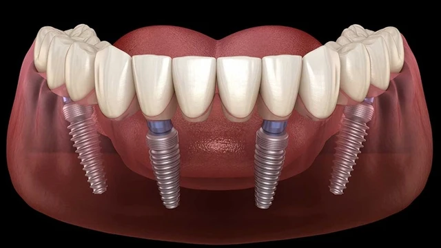bai-viet/giai-phap-phuc-hinh-rang-implant-all-on-4-uu-va-nhuoc-diem.html
