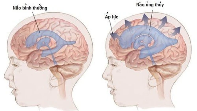 bai-viet/gian-nao-that-o-thai-nhi-la-gi-can-lam-gi-khi-thai-nhi-bi-gian-nao-that-64184.html