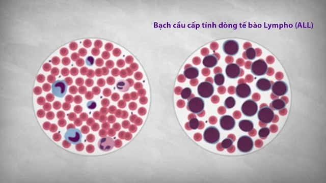 bai-viet/gioi-thieu-ve-benh-bach-cau-cap-dong-lympho-o-tre-em-56906.html