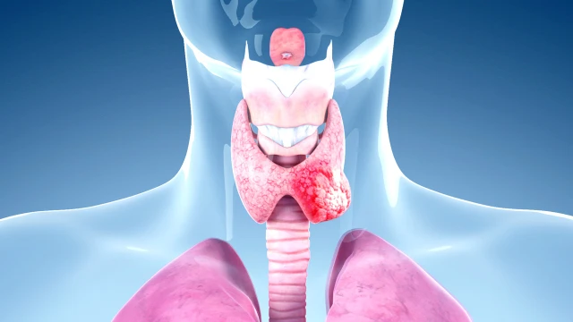 bai-viet/goc-giai-dap-benh-cuong-giap-co-phai-la-ung-thu-tuyen-giap-khong.html