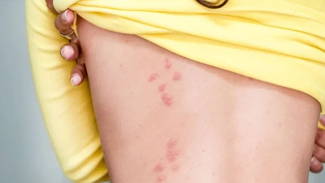 bai-viet/goc-giai-dap-bi-rep-giuong-can-boi-thuoc-gi.html