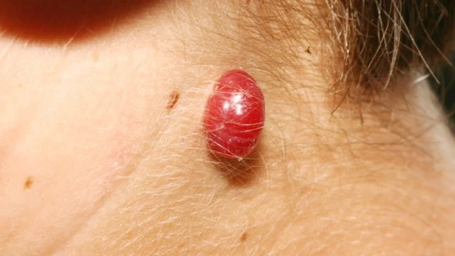 bai-viet/buou-mau-o-nguoi-lon-co-nguy-hiem-khong-cac-cap-do-cua-benh-buou-mau.html