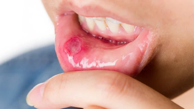 bai-viet/daktarin-oral-gel-co-tri-nhiet-mieng-khong-cach-su-dung-daktarin-oral-gel.html