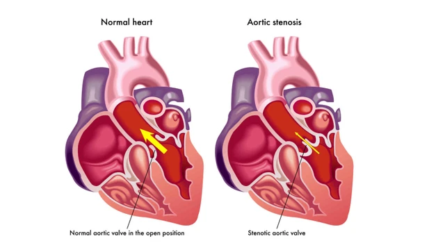 bai-viet/hep-van-tim-2-la-co-chua-duoc-khong-phuong-phap-dieu-tri-hep-van-tim-2-la.html