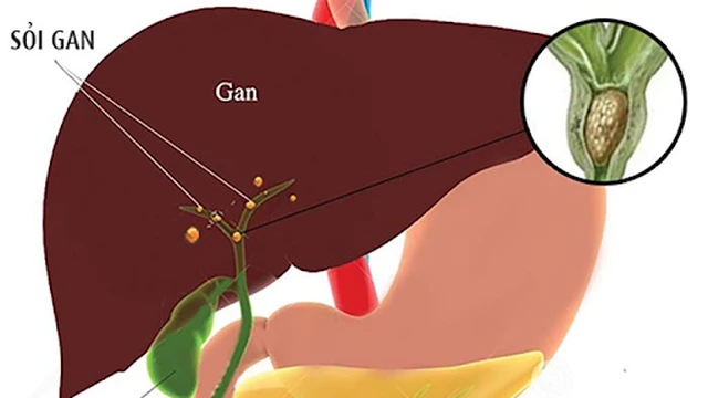 bai-viet/giai-dap-soi-mat-gan-la-gi-54802.html
