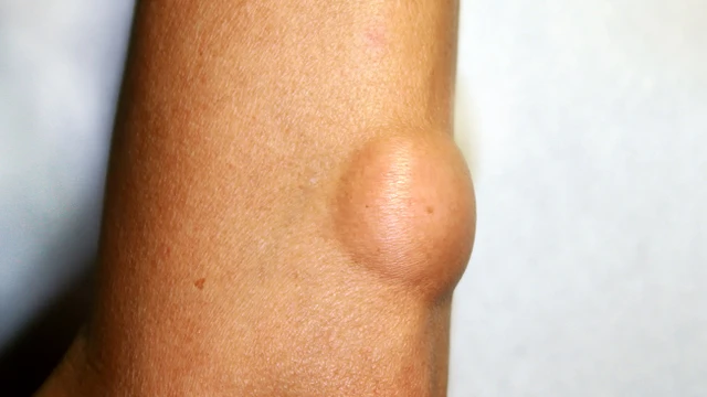 bai-viet/goc-giai-dap-thac-mac-kham-u-mo-o-benh-vien-nao-tai-ha-noi.html