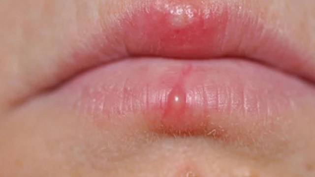 bai-viet/goc-moi-ngay-mot-luu-y-can-lam-gi-khi-tre-so-sinh-bi-rop-trang-o-moi-59205.html