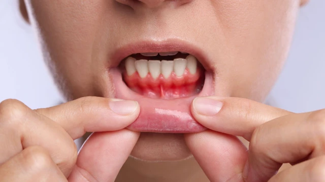 bai-viet/gom-mem-la-dau-hieu-cua-benh-gi-khi-nao-can-kham-tai-co-so-y-te.html