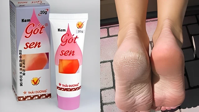 bai-viet/got-sen-review-kem-tri-nut-got-chan-got-sen-co-thuc-su-hieu-qua.html