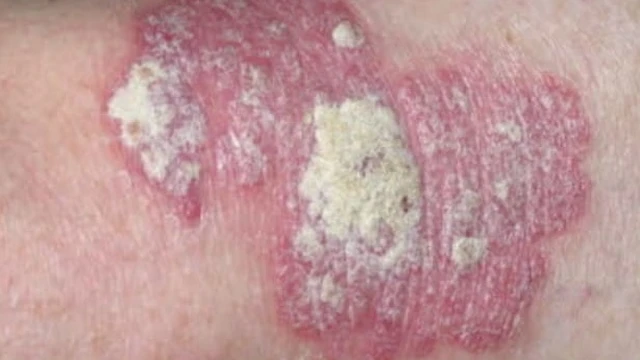 bai-viet/hac-lao-da-sac-la-gi-cach-dieu-tri-hac-lao-dang-da-sac-55527.html