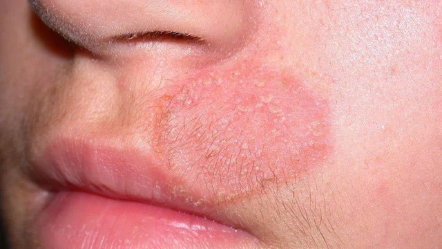 bai-viet/hac-lao-giai-doan-dau-dau-hieu-va-dieu-tri-55097.html