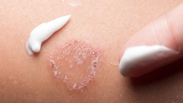 bai-viet/hac-lao-lau-nam-co-the-chua-khoi-khong-55237.html