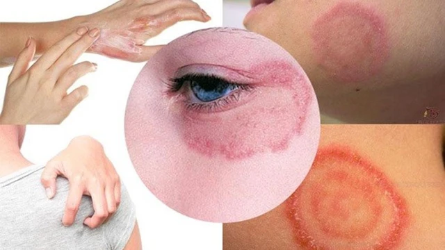 bai-viet/hac-lao-mung-mu-co-gay-nguy-hiem-khong-55252.html