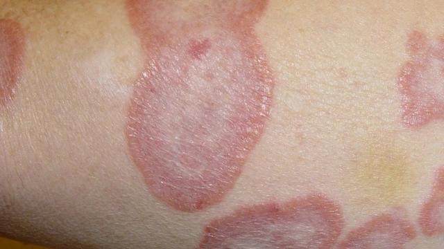 bai-viet/hac-lao-o-hang-nam-gioi-nguyen-nhan-va-cach-dieu-tri-dut-diem-khong-tai-lai-55574.html